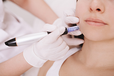 Science of Microneedling | New Life Aesthetics