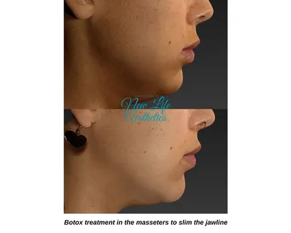Botox Treatment Raleigh NC