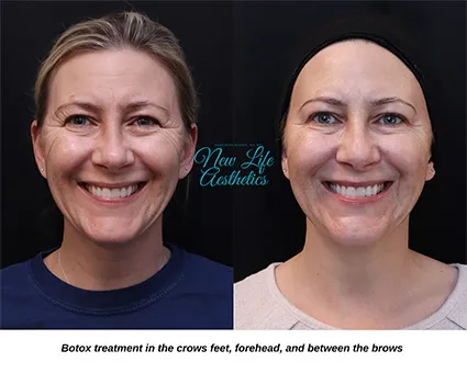 Botox Treatment Raleigh NC