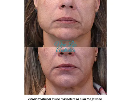 Botox Treatment Raleigh NC