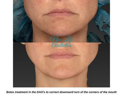 Botox Treatment Raleigh NC