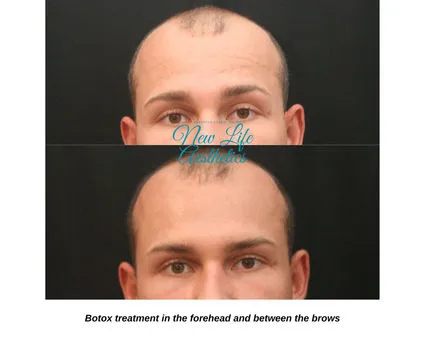 Botox Treatment Raleigh NC