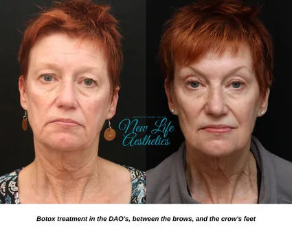 Botox Treatment Raleigh NC