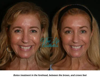 Botox Treatment Raleigh NC