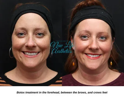 Botox Treatment Raleigh NC