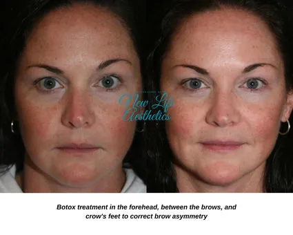 Botox Treatment Raleigh NC
