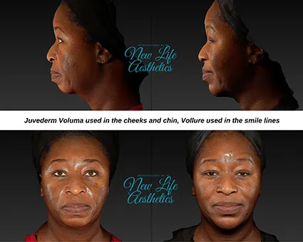 Juvederm Filler Treatment Raleigh NC
