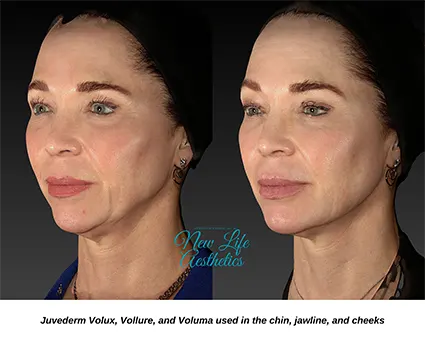 Juvederm Filler Treatment Raleigh NC