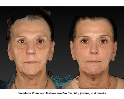 Juvederm Filler Treatment Raleigh NC