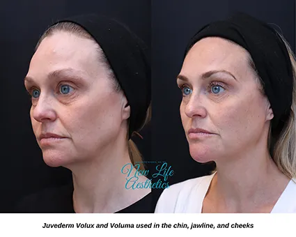 Juvederm Filler Treatment Raleigh NC