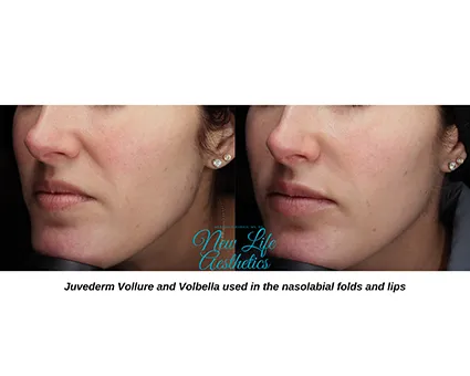 Juvederm Filler Treatment Raleigh NC