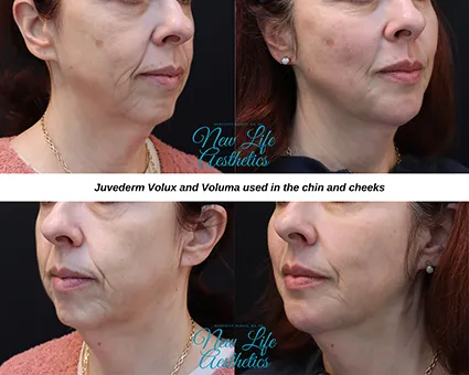 Juvederm Filler Treatment Raleigh NC