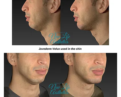 Juvederm Filler Treatment Raleigh NC