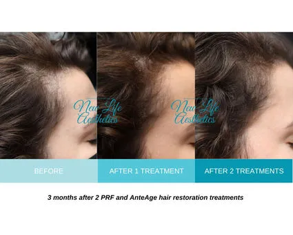 PRF and AnteAge Hair Restoration Treatment Raleigh NC