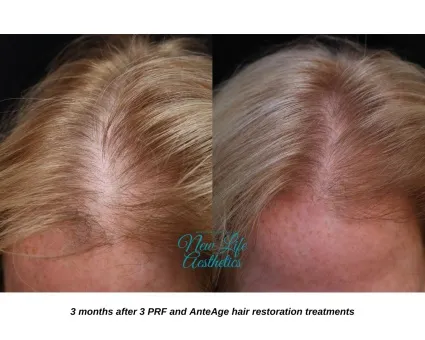 PRF and AnteAge Hair Restoration Treatment Raleigh NC