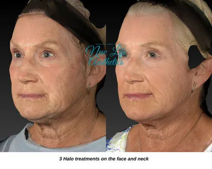 Halo Hybrid Fractional Laser Treatment Raleigh NC