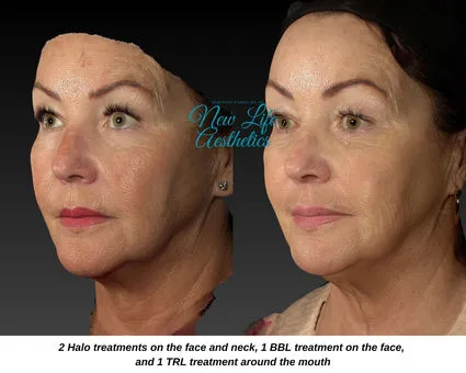 Halo Hybrid Fractional Laser Treatment Raleigh NC