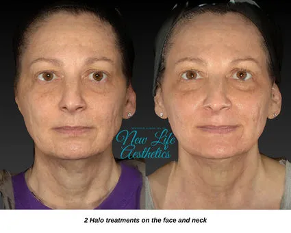 Halo Hybrid Fractional Laser Treatment Raleigh NC