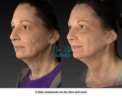Halo Hybrid Fractional Laser Treatment Raleigh NC