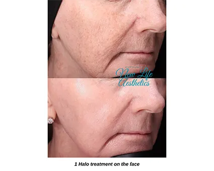 Halo Hybrid Fractional Laser Treatment Raleigh NC