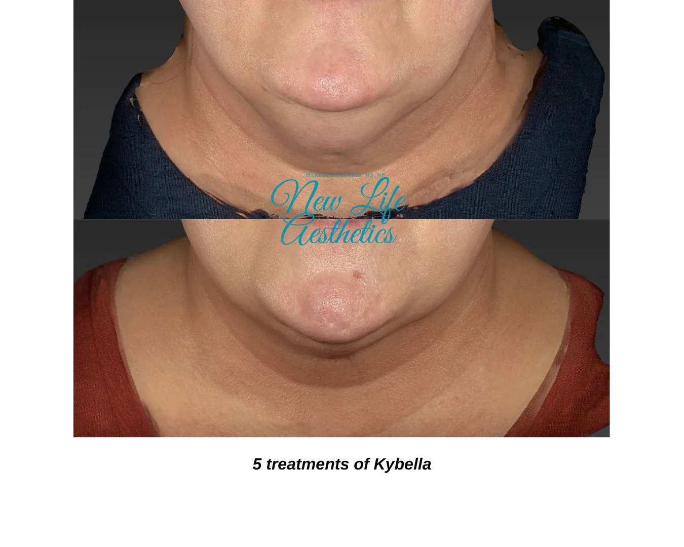 Kybella Treatment Raleigh NC