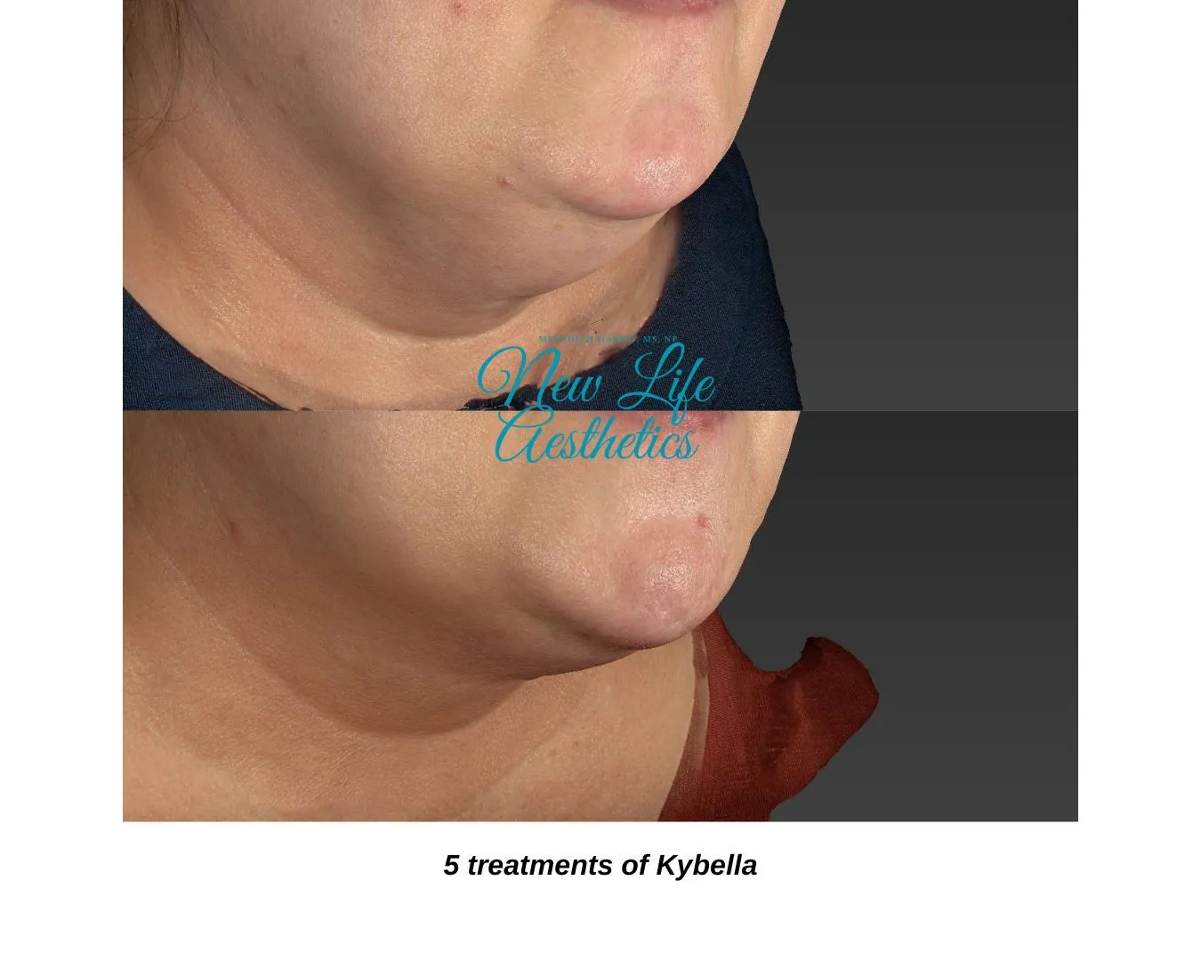 Kybella Treatment Raleigh NC