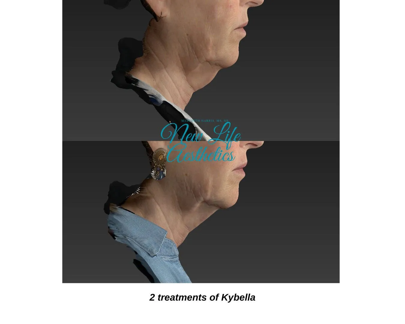 Kybella Treatment Raleigh NC