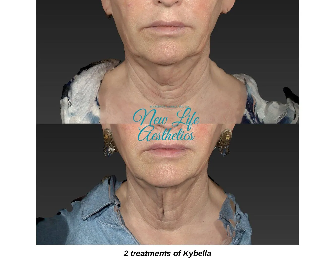 Kybella Treatment Raleigh NC