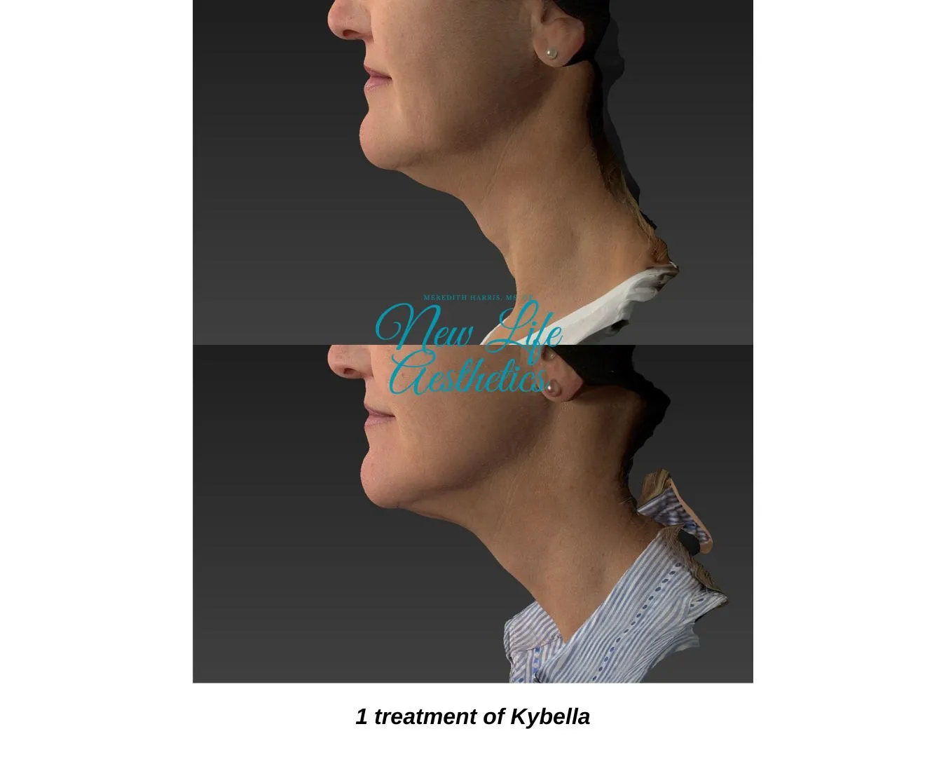 Kybella Treatment Raleigh NC