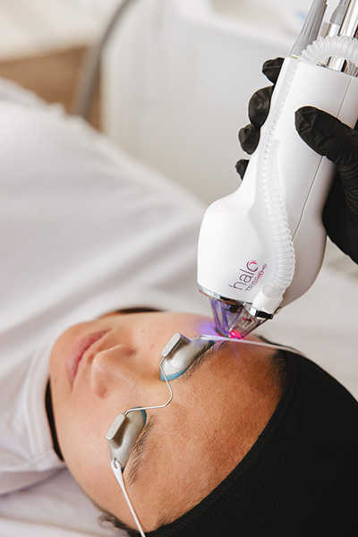 Sciton Halo Tribrid Laser Skin Resurfacing in Raleigh NC
