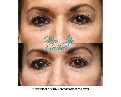 PDO Thread Treatment Raleigh NC