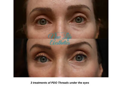 PDO Thread Treatment Raleigh NC