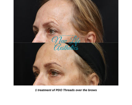 PDO Thread Treatment Raleigh NC