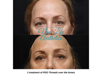 PDO Thread Treatment Raleigh NC