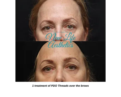 PDO Thread Treatment Raleigh NC