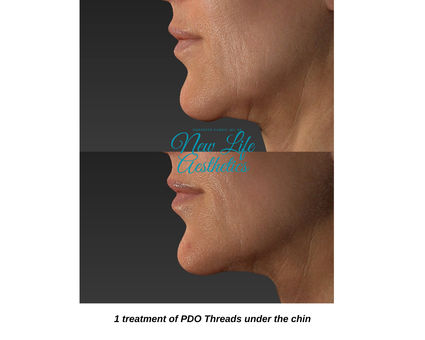 PDO Thread Treatment Raleigh NC