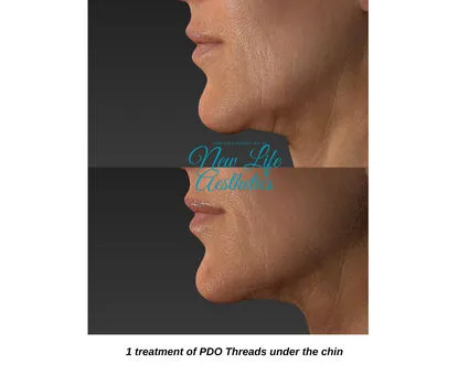 PDO Thread Treatment Raleigh NC