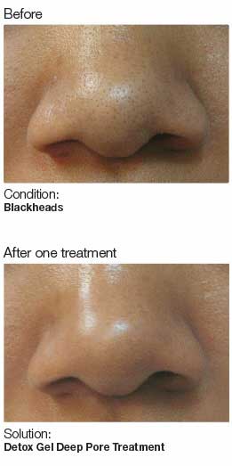 Chemical Peel Raleigh NC