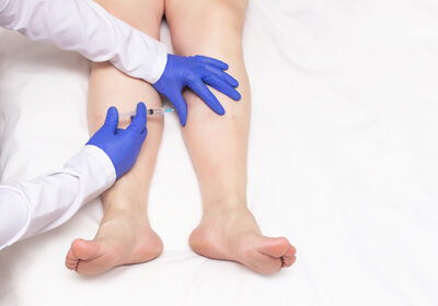 Sclerotherapy Raleigh NC