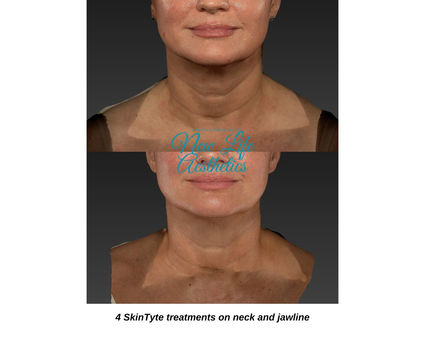 SkinTyte Treatment Raleigh NC