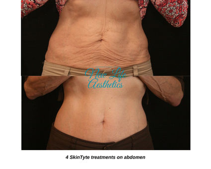 SkinTyte Treatment Raleigh NC