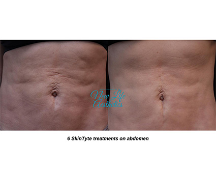 SkinTyte Treatment Raleigh NC