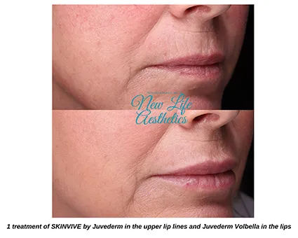 Skinvive Treatment Raleigh NC