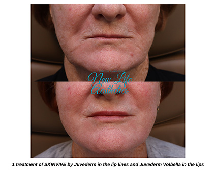 Skinvive Treatment Raleigh NC