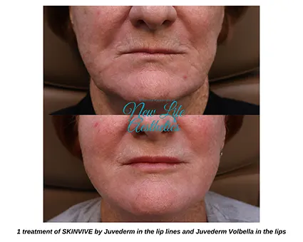 Skinvive Treatment Raleigh NC