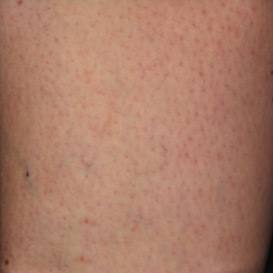 Sclerotherapy in Raleigh NC