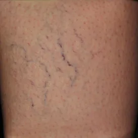 Sclerotherapy in Raleigh NC