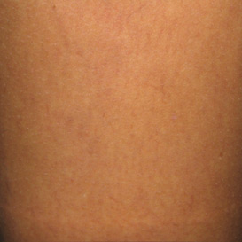 Sclerotherapy in Raleigh NC