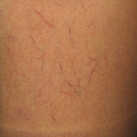 Sclerotherapy in Raleigh NC