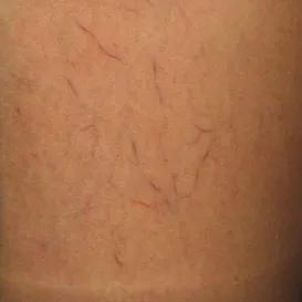 Sclerotherapy in Raleigh NC